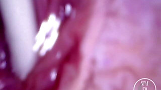 POV Endoscope Catheter Bladder Inflation